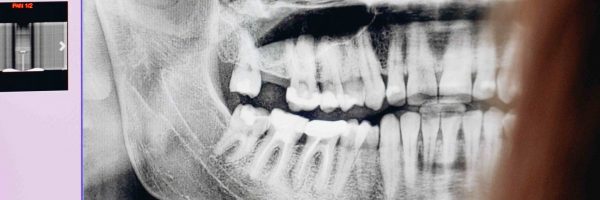 Radiografía dentadura